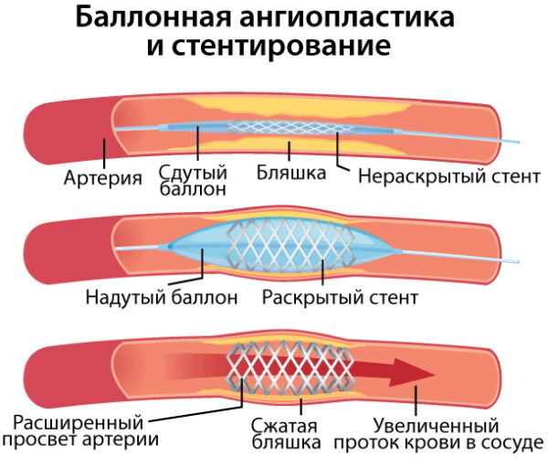 Ikke-stenotisk aterosklerose av BCA (brachiocephalic arteries)