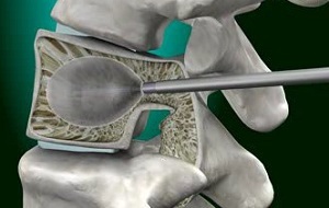 Kifoplasty - tehnika mugurkaula funkciju atjaunošanai