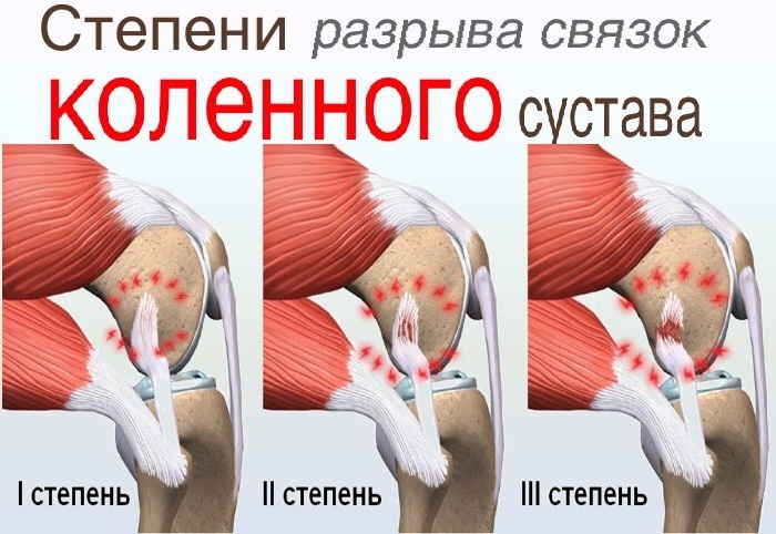 Knee ligament rupture. Symptoms, treatment, anterior cruciate, medial collateral, internal lateral