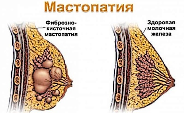Colitis in the sternum on the left, in the middle, on the right, periodically. Causes when inhaling, coughing, panic attacks