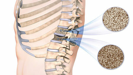 Symptomer på osteoporose
