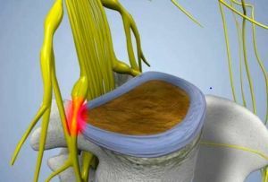 pinch of the sciatic nerve