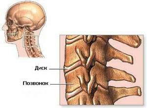 Ostéochondrose de la colonne cervicale