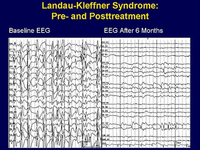Electroencephalography with Landau syndrome