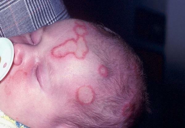Lichen rose chez les bébés