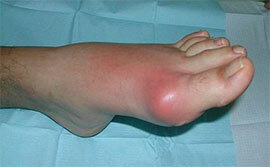 Diseases of the foot joints