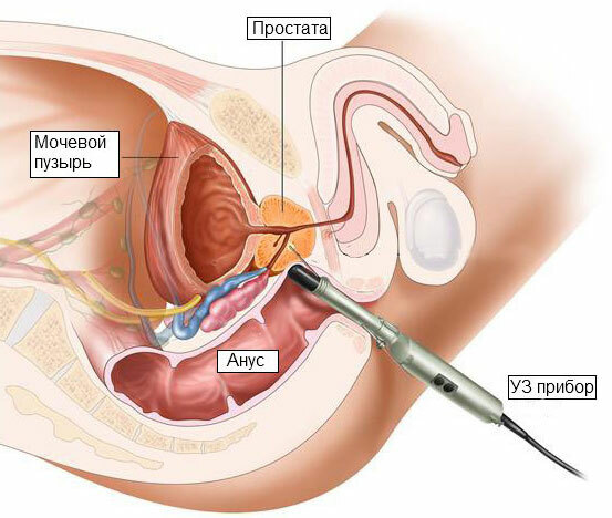 La prostatite bactérienne - qu'est-ce que c'est, le traitement, les symptômes et les signes