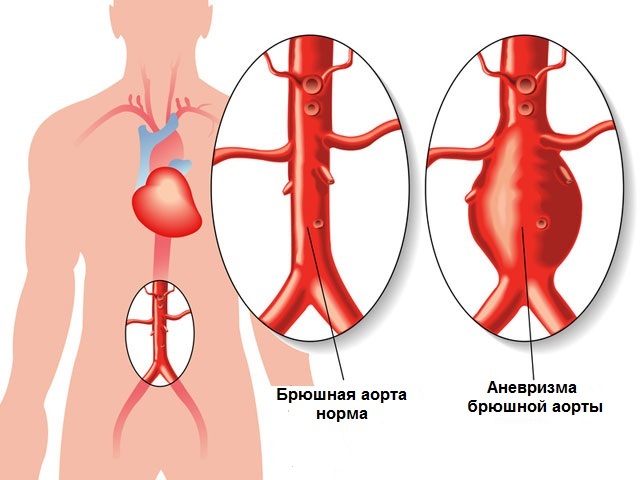 Aterosklerose i aorta i hjertet. Hva er det, hva betyr veggtetting?