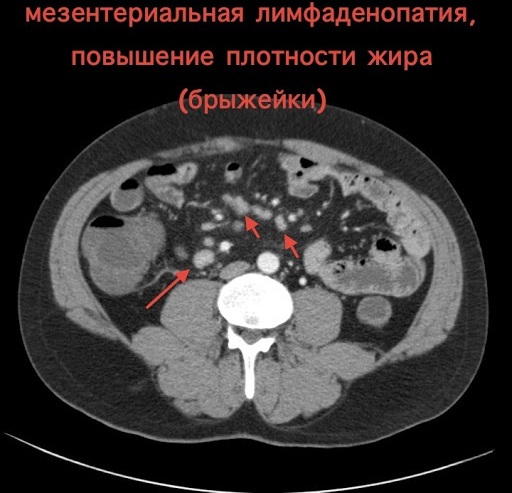 Mesenteric lymphadenopathy in children of the abdominal cavity, intestines. Causes, treatment