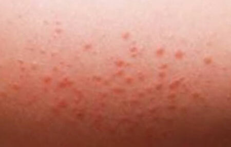 rash with meningitis photo