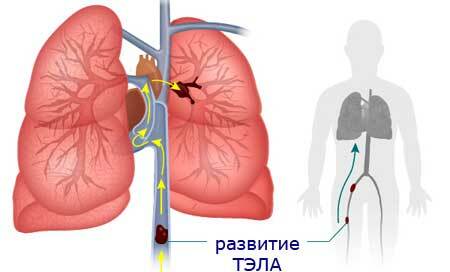 Plaušu artērijas trombembolija