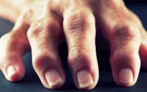 artrose van de vingers van de derde fase
