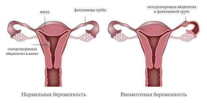 Shematski prikaz ektopične trudnoće