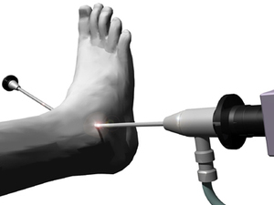 Arthroscopy of the ankle
