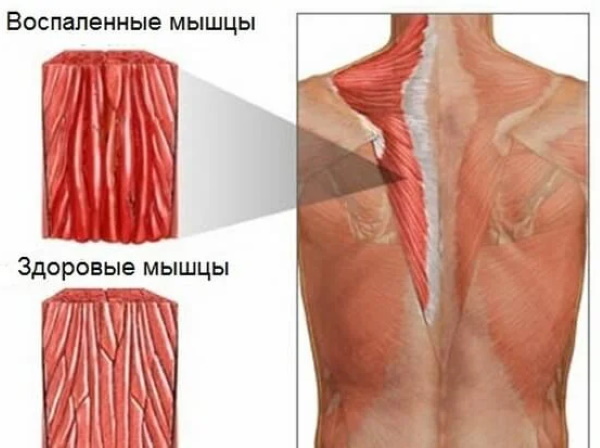Muscle pain throughout the body. Causes and treatment
