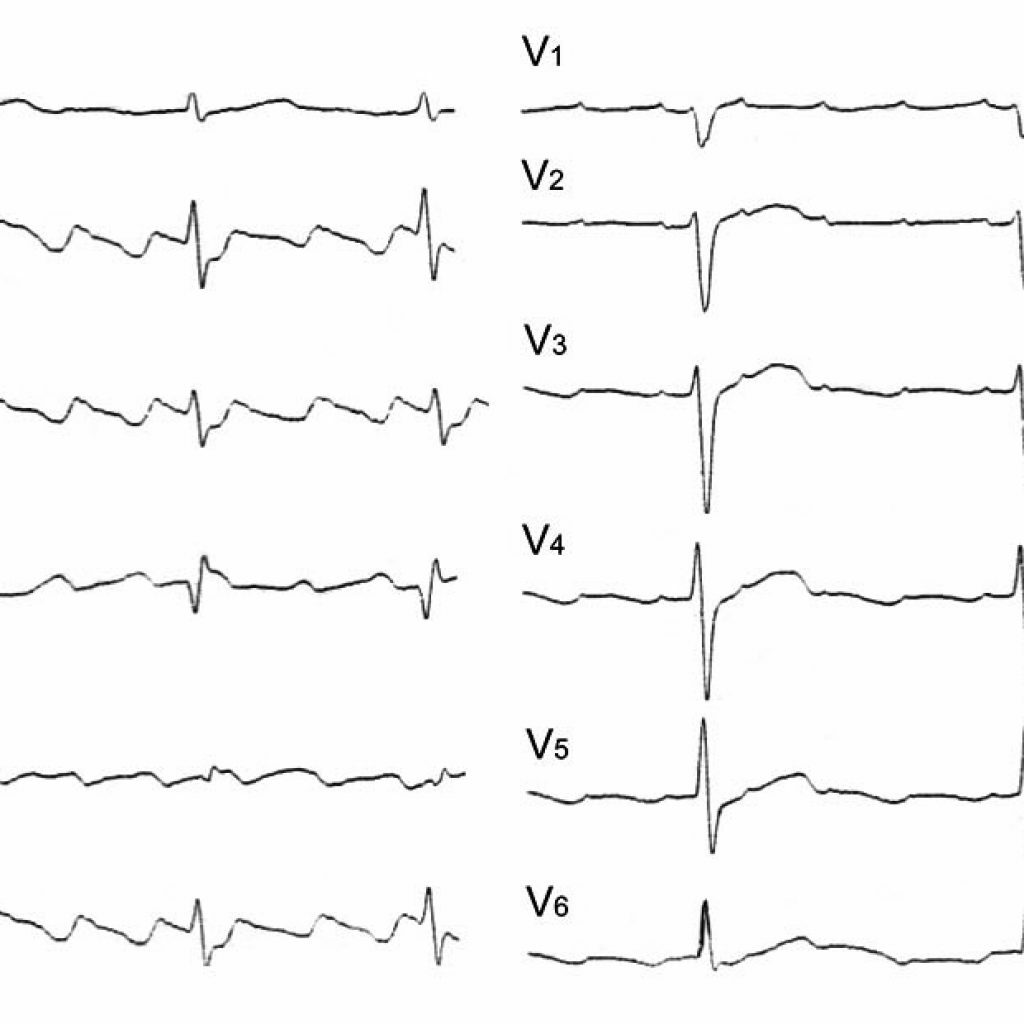 Ablația radiofrecventa a inimii: indicații și contraindicații, etape de operare, recenzii ale cardiologilor și pacienților + fotografii și video