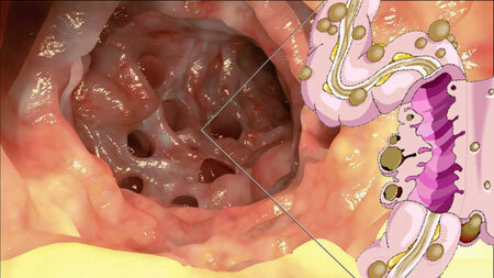 Diverticulosis del intestino: ¿qué es? Síntomas y tratamiento