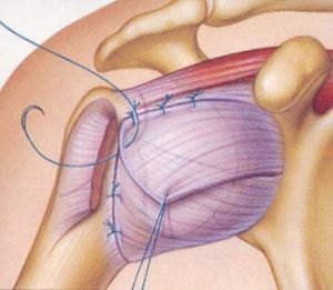 Why the habitual dislocation of the shoulder can not be cured without surgery