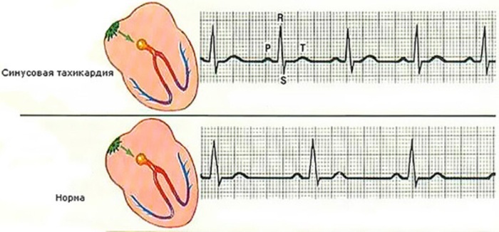 Sinus tachycardia of the heart in women, children, adults. What is it, symptoms, how to treat
