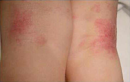 Wet eczema: simptomi un ārstēšana, foto