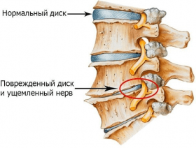 Pellizcar el nervio en la columna vertebral