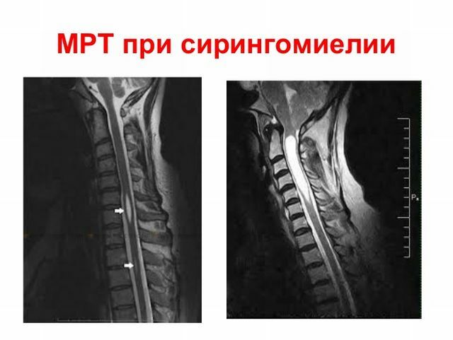 MRI so syringomyeliou