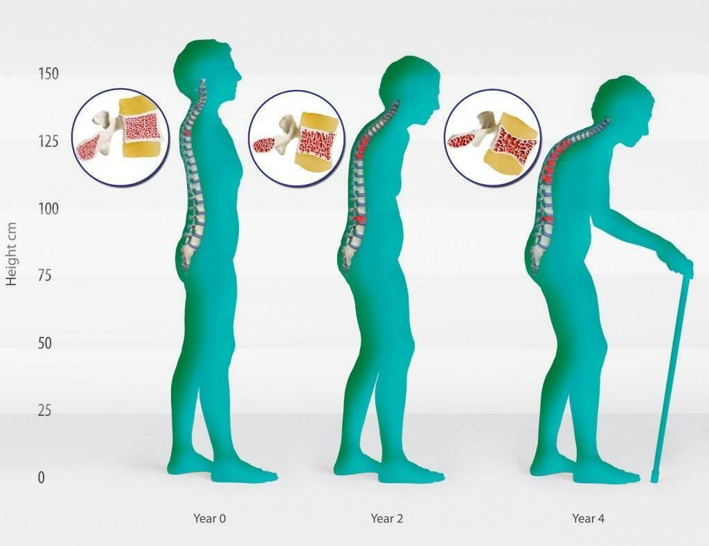 Development of osteoporosis