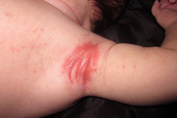 Barnets udslæt under armene er rødt. Hvad betyder det, årsager, behandling