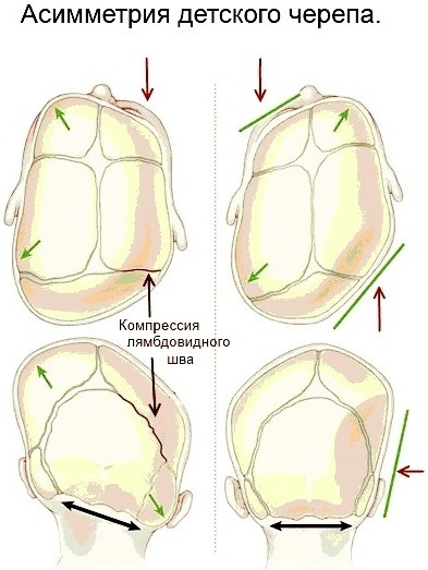 Galvaskausa deformācija jaundzimušajiem, bērniem, ar mugurpuses prezentāciju. Pazīmes, simptomi, kā to novērst