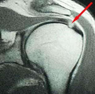 Tendonitis of the rotator cuff of the shoulder