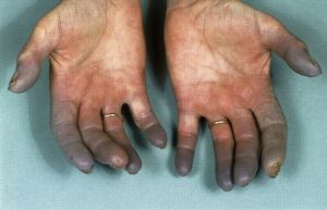 angiotrophoneurosis of the upper limbs