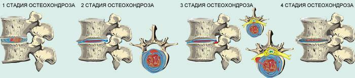 En visuel repræsentation af graden af ​​udvikling af osteochondrose