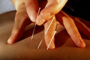 akupunktúra