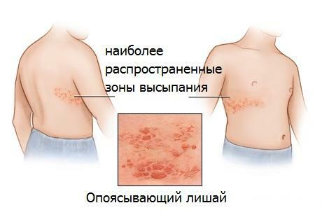The most common areas of rash