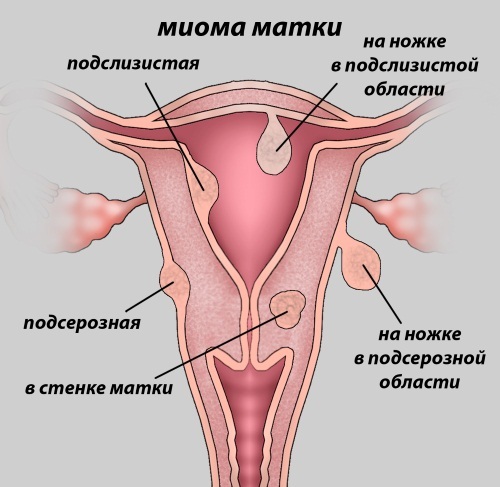 Kaip sustabdyti kraujavimą iš gimdos be ligoninės dėl miomų, menstruacijų, endometriozės, persileidimo