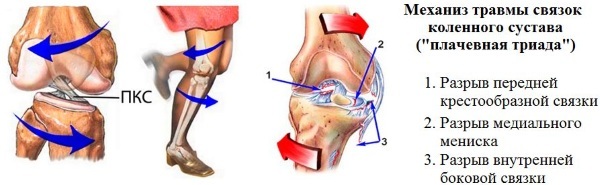 Rotura del ligamento de la rodilla. Síntomas, tratamiento, cirugía.
