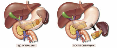 Pankreatit ile pankreasta operasyon: Sonuçlar, diyet, beslenme