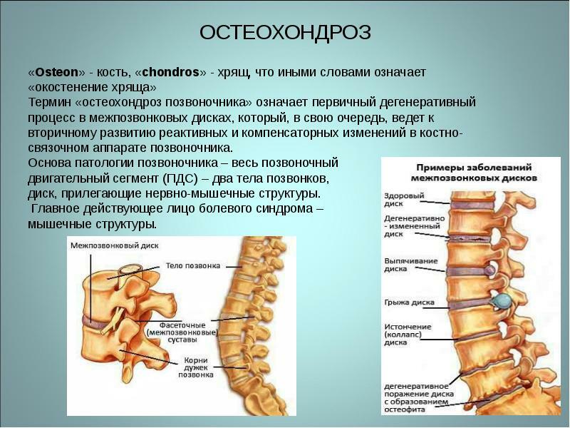osteocondrosi