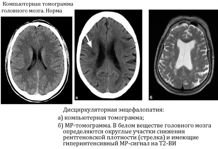 Perinatal encefalopati. Hva er det hos barn, voksne, symptomer, konsekvenser