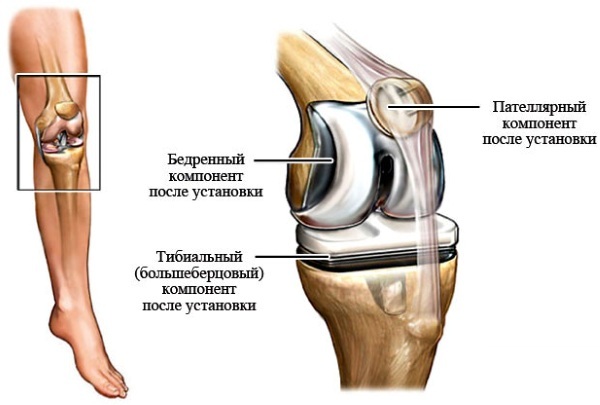 Osteoarthritis of the knee joint of 3 degrees. Treatment folk remedies, the laser, on Bubnovskogo, the operation