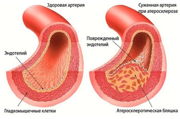 How to clean the blood vessels in the home of blood clots, plaque, cholesterol. Folk and medications