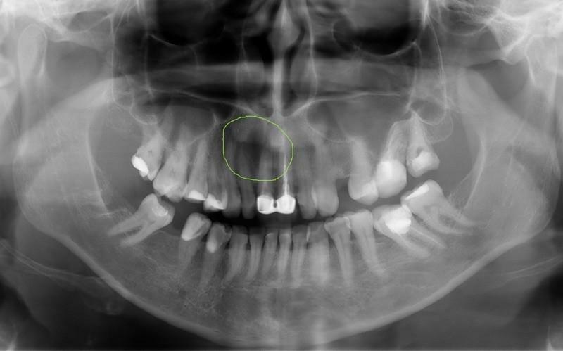 Cyste van tand op X-ray