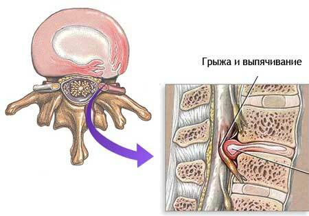 Hernia en la columna cervical