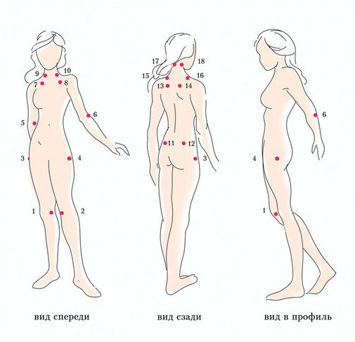 Tipiniai vietiniai skausmo sindromai fibromialgija