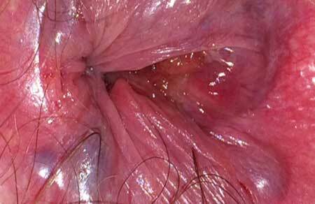 Simptomi hemoroidnog čvora