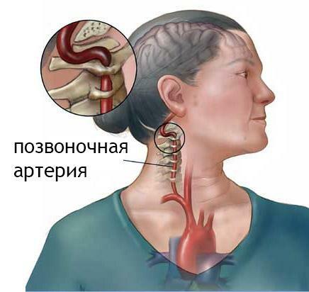 Sindrom sindroma vretenčne arterije hrbtenice
