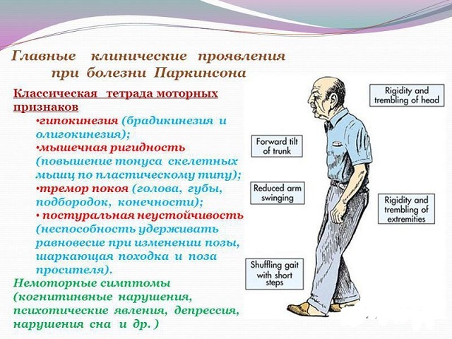 A Parkinsonizmus tünetei