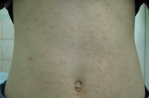 Scabies on the abdomen
