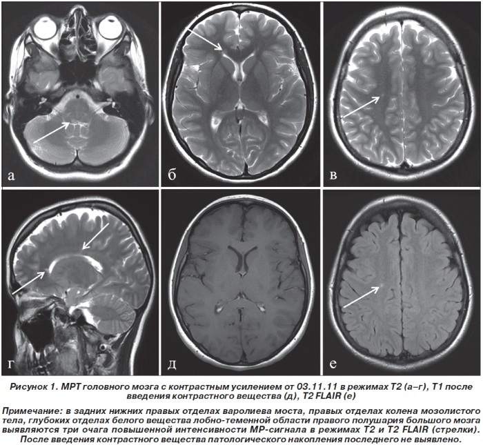 Contrast with MRI. What is it, contraindications, complications, types that are administered
