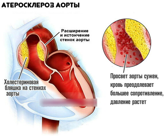 Sydämen aortan ateroskleroosi. Mitä se on, mitä seinien tiivistäminen tarkoittaa?